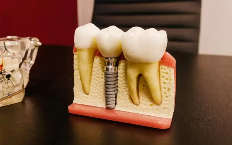 dental implants